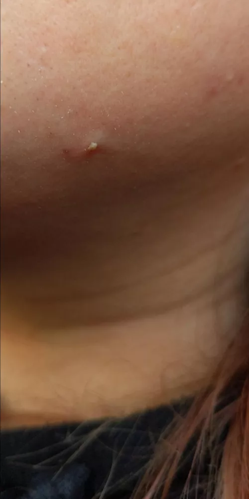 Nice big white head on my jaw, possibly an ingrown hair, get plenty of these thanks to PCOS.