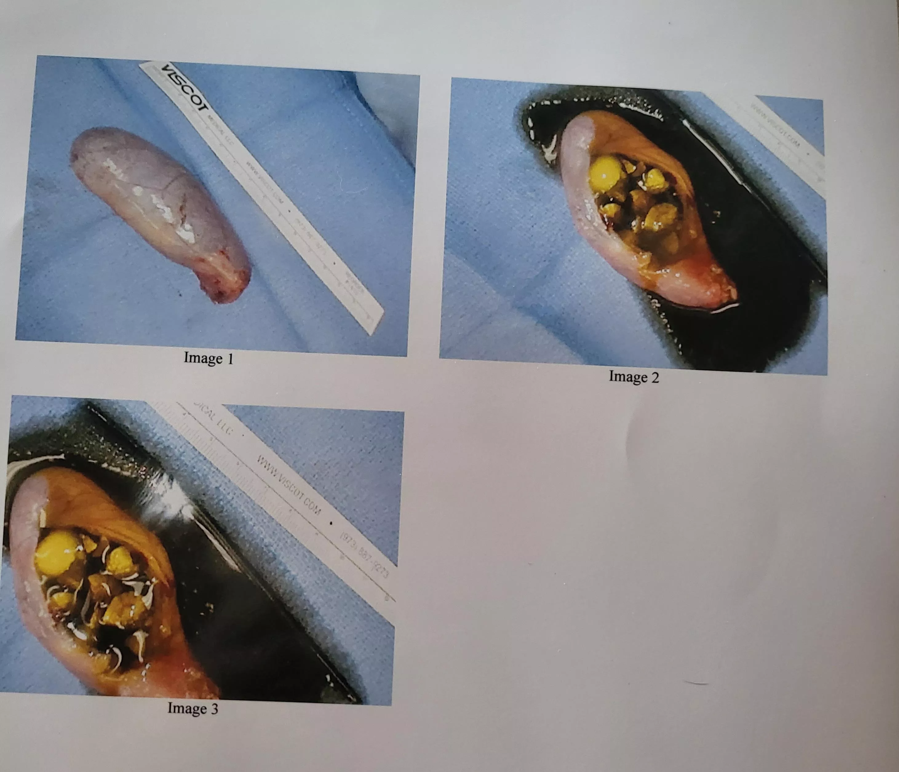 Not your average pop: Got my gallbladder taken out today and had my surgeon disect it to show me, she was ready to bust!