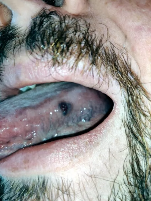 Red lump on tongue - very rare, begign Masson's tumor. Surgically removed later