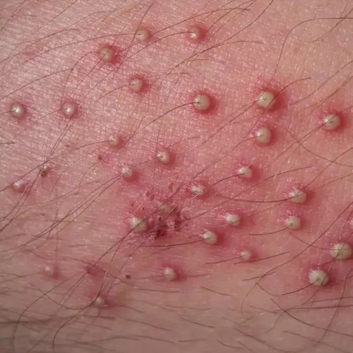 Saw this picture when googling pimple hairs. I would pay GOOD money to pluck those hairs out and pop the pus out after 🤤😭