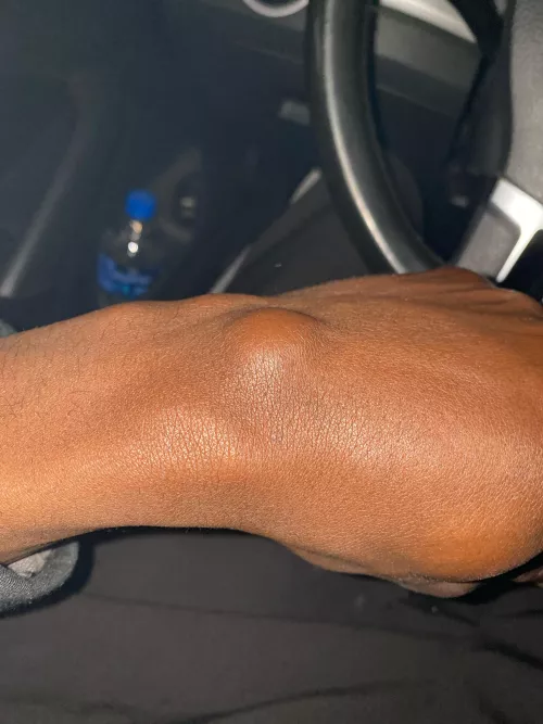 Should I pop it. I’ve had for about a year and half same size no pain