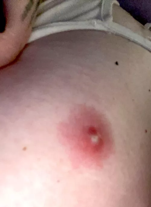 Should I pop this? It’s on my chest???