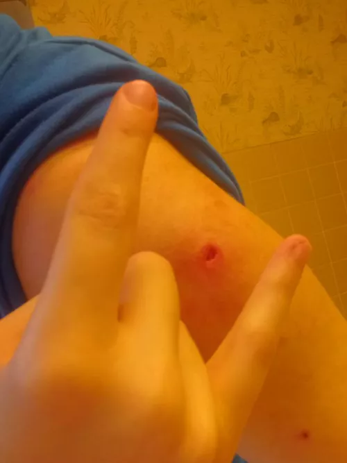 The big ass gnarly hole in my arm after popping a really bad pimple. It felt so much better after I got all the crap out