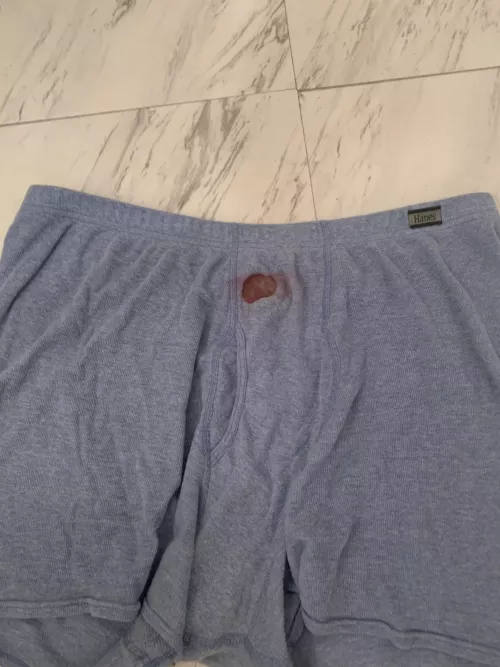 The other night I had a boil pop in my sleep. Here is the aftermath