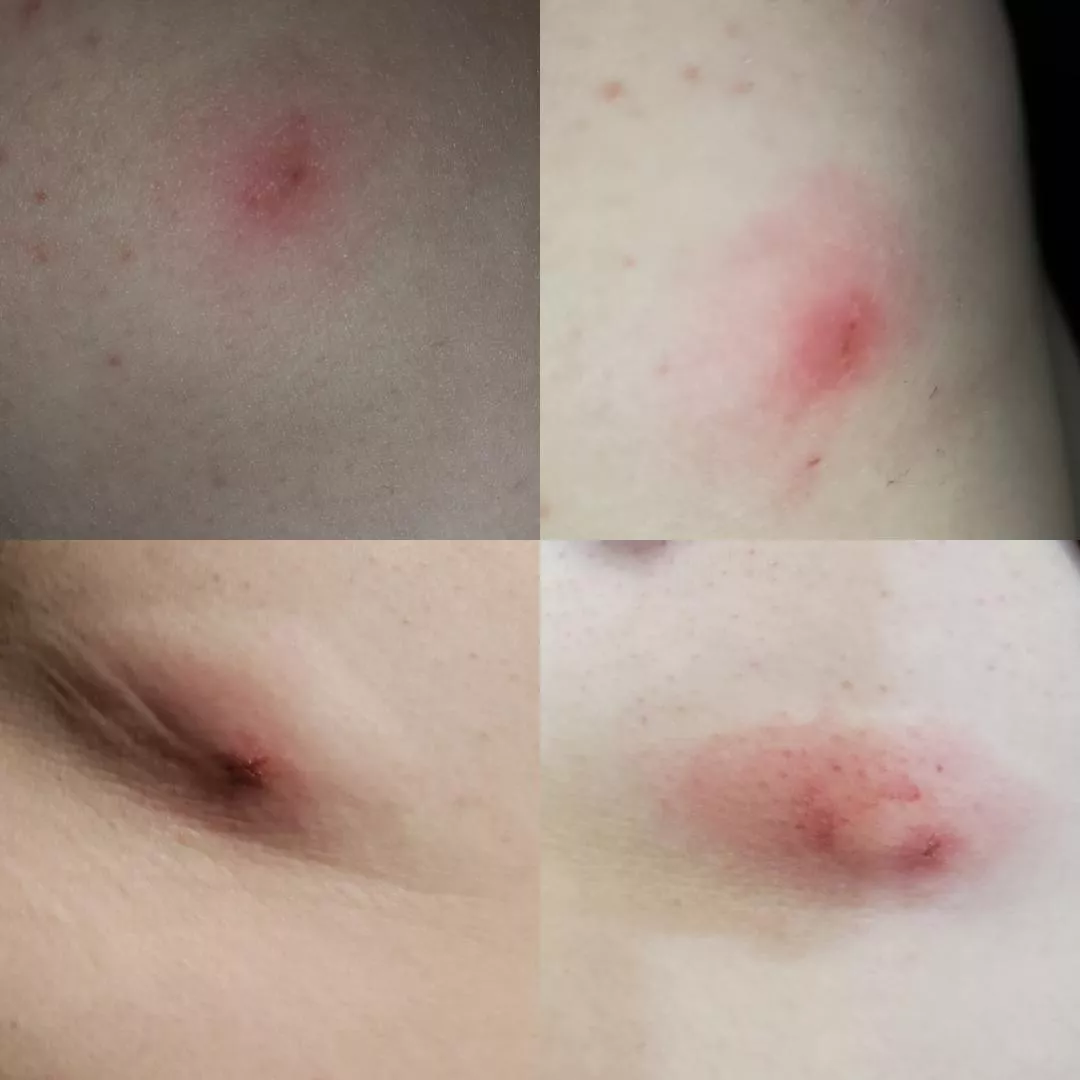 The progression of what I believe to be a spider bite on my side over just 24 hours. (yes I've seen a dr. )