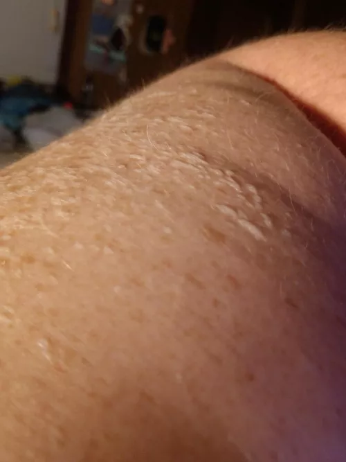 These are incredibly tiny, itchy, blisters.