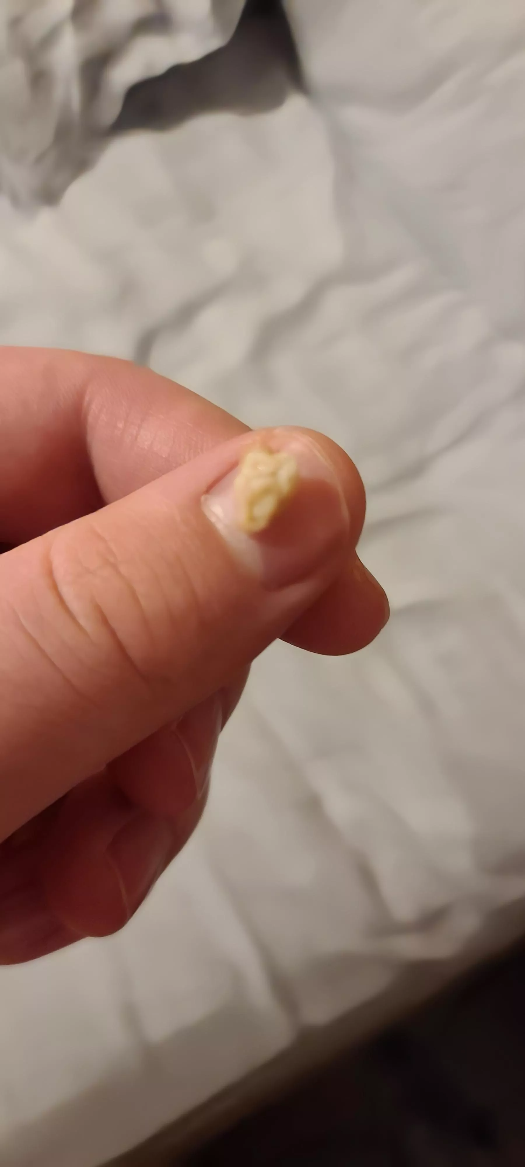 this bad boy came out of my tonsils when i woke up