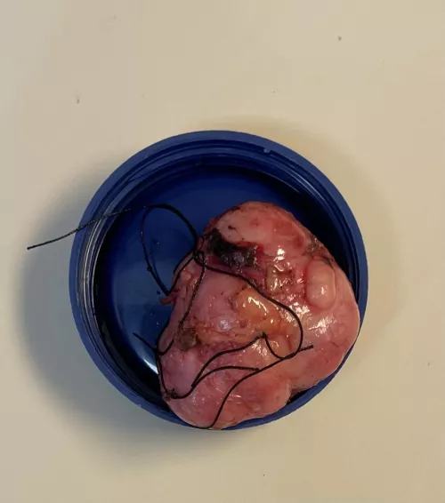 This is Frank, a 20 gram 4.4 x 3.5 x 2.5 (doctor’s official measurement) fibro adenoma removed from my left breast, hence why video was not allowed. He was a beast, but Frank has been yanked!