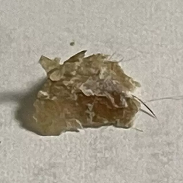 This isn’t a pop but it’s what I find once a month between my big toe and the one next to it! Dead skin and sebum mixture, with hair coming out of it! About the size of a dime. Fun, huh?!