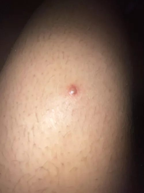 This randomly appeared on my thigh..anyone know what it is?? It hurts to touch