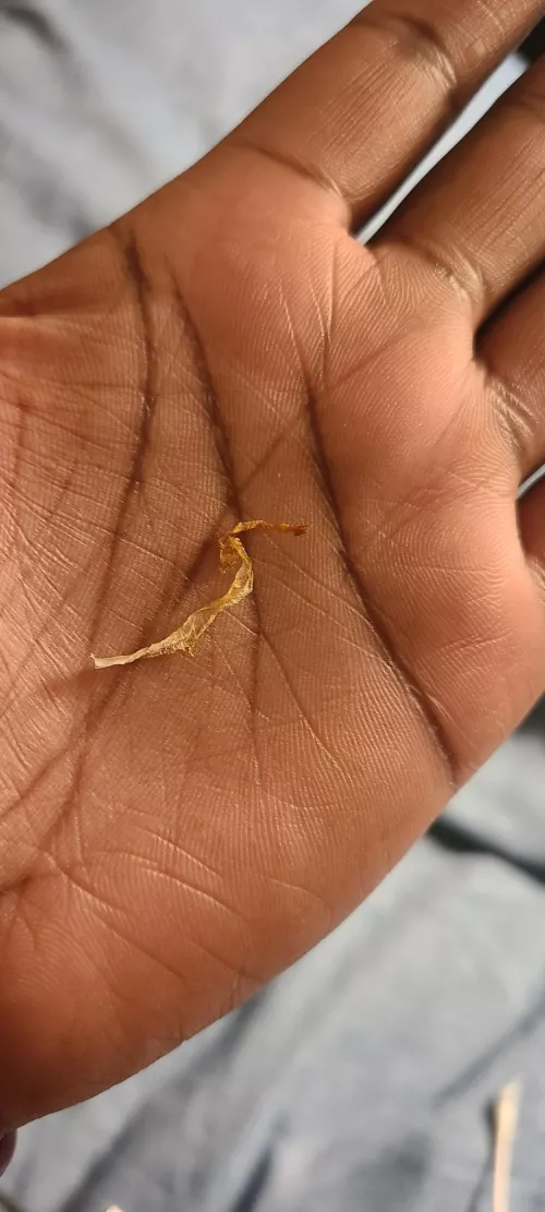 Two Years Later: I have my fourth Ear Wax Sperm!!! (Story and previous posts in comments)