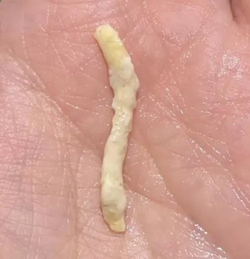 Unexpected Rubbery Noodle Blocking Tear Duct