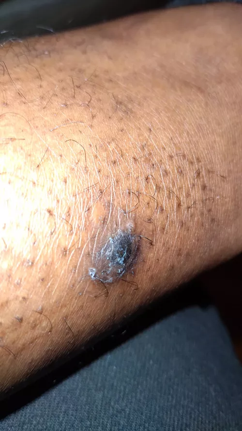 Update: Doctor said it looks like a blister referenced me to a walk in dermatologist