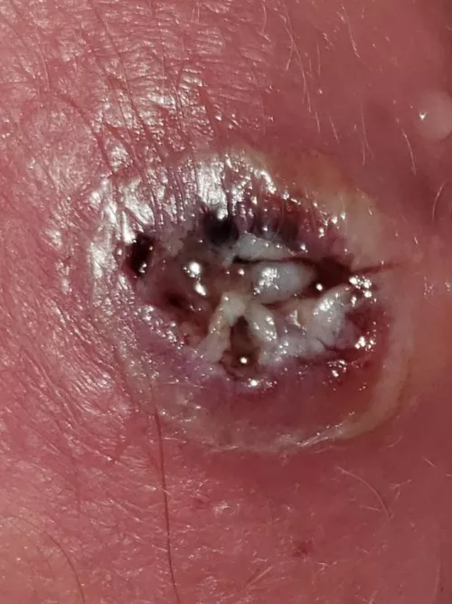 Update: My pilonidal cyst after draining and showering.