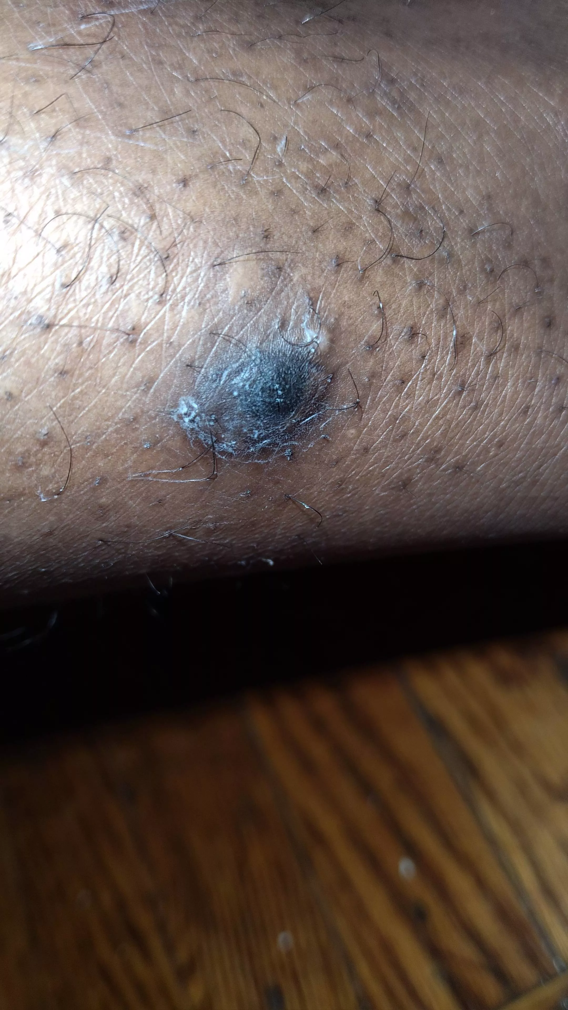 Update Pt.4 Doctor said it looked infected gave me pills and cream.