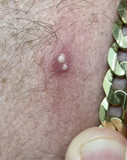 Woke up with 2 holes surrounded by redness on my neck. I thought was a spider bite, but now I’m not sure.