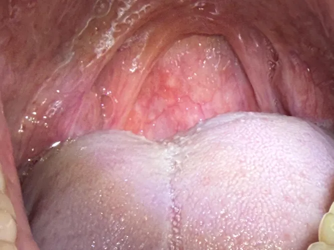 12-Day Sore Throat Not Strep with White Bump in Back of Mouth, Cannot See Doctor Due to Blizzard