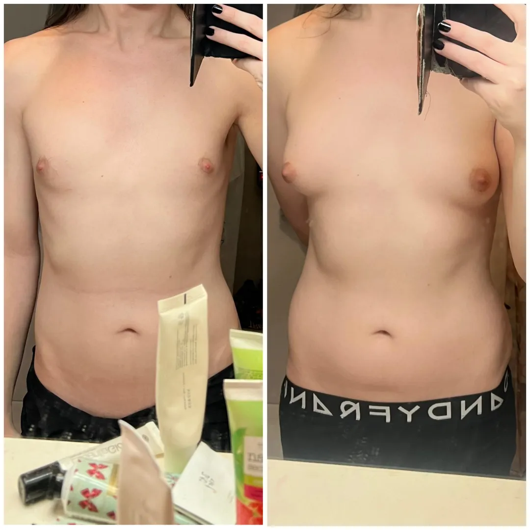 26, 12 months hrt, estrogel+spiro.