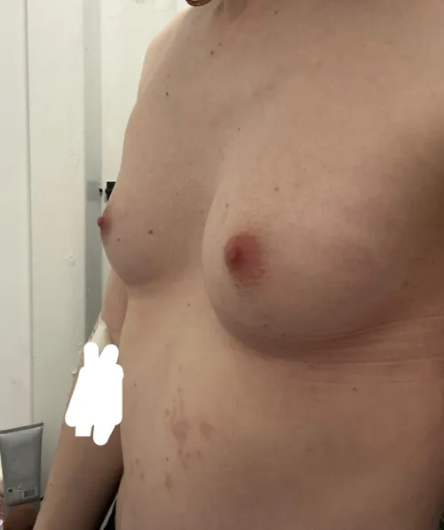 4 years, 6mg EEN IM monotherapy