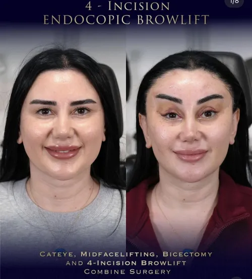 4-Incision Brow Lift!