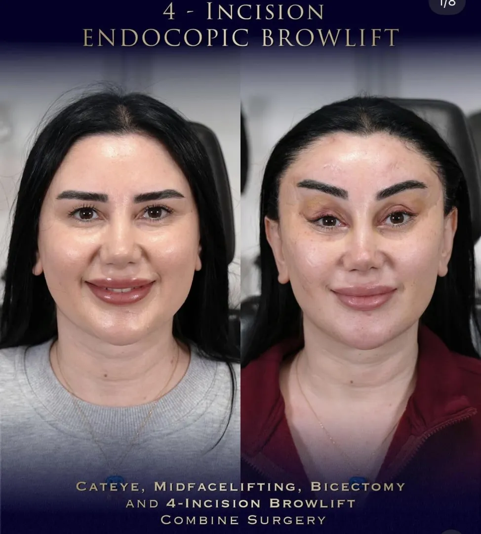 4-Incision Brow Lift!