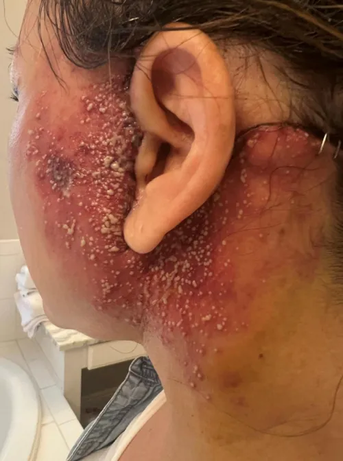 Acute localized exanthematous pustulosis 36 hours after facelift
