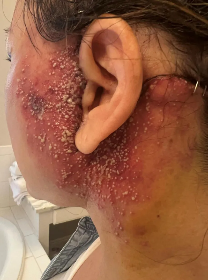 Acute localized exanthematous pustulosis 36 hours after facelift
