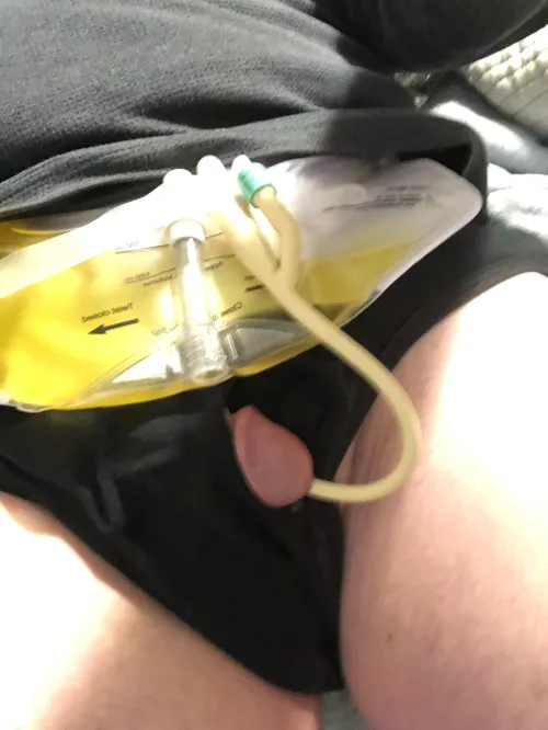 Almost ready for bed with my Bardex I.C. 14 Fr Foley Catheter