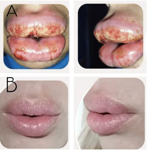 Angioedema and bacterial and viral Infection following hyaluronic acid fillers injection to the lips