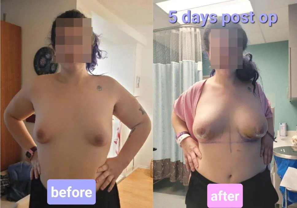 Before/After Breast Augmentation