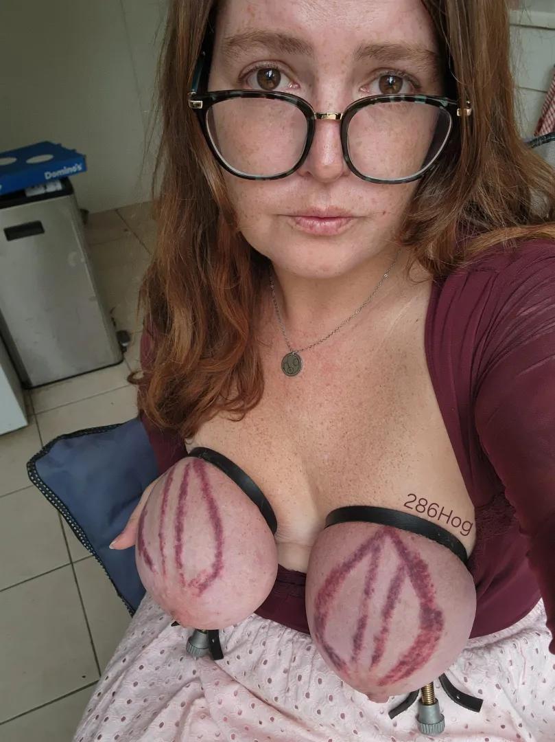 Big boobs, freshly bruised 