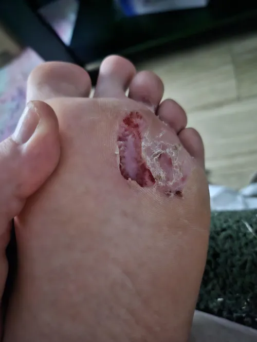 Chronic blisters + life long athletes foot + a bad scratching in my sleep habit = this