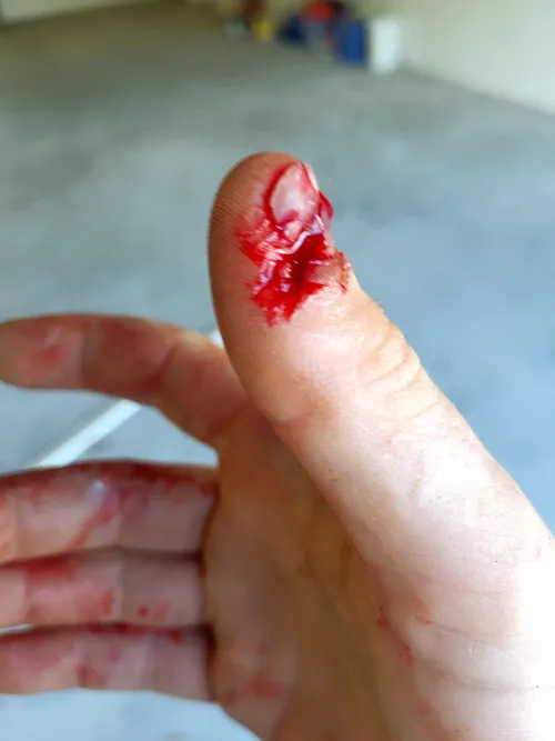 Circular saw kicked back on me and ran over my thumb.