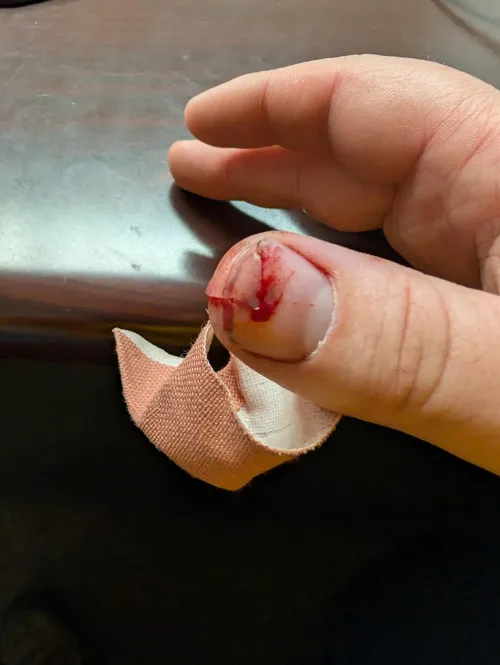 Cut finger from a tree branch