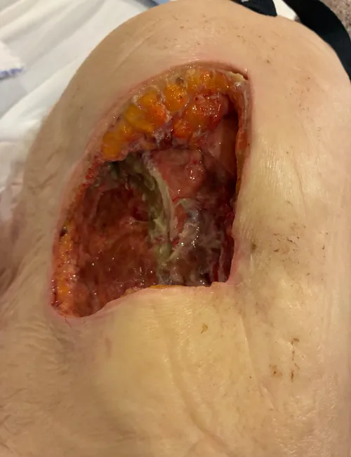 Decubitus ulcer I had the pleasure of doing a wet to dry dressing on the other night. The tunnels were never ending.