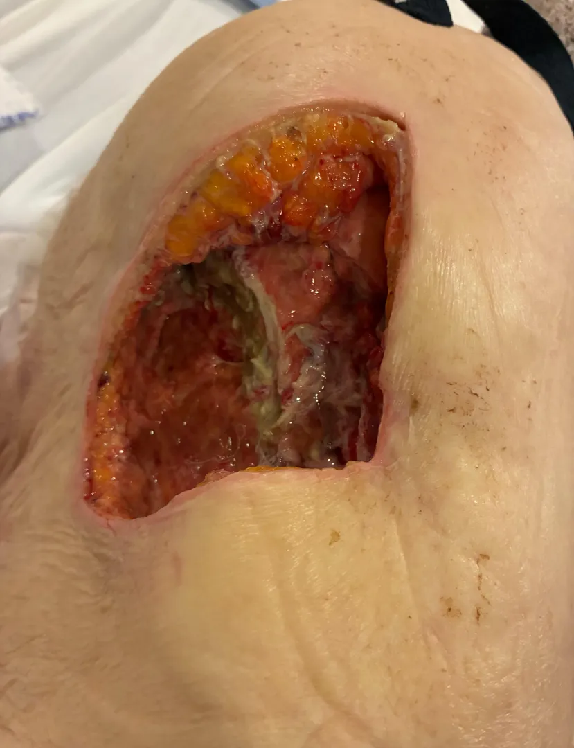 Decubitus ulcer I had the pleasure of doing a wet to dry dressing on the other night. The tunnels were never ending.