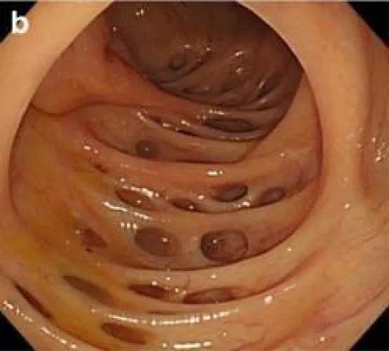 Diverticulosis in the colon. Present in 80% of people over 70 years old