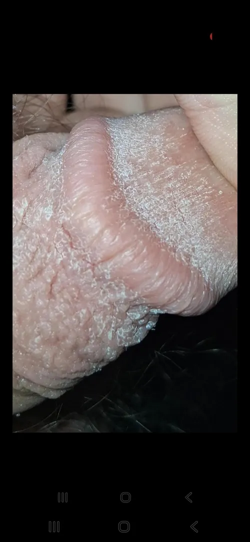 Dry skin on penis? Or is it a STD?I just noticed it earlier today. 18M
