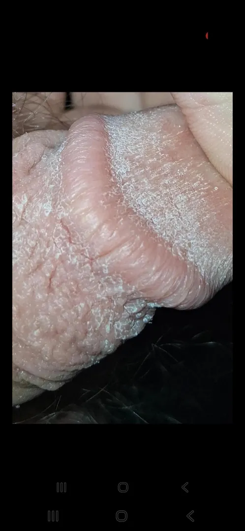 Dry skin on penis? Or is it a STD?I just noticed it earlier today. 18M