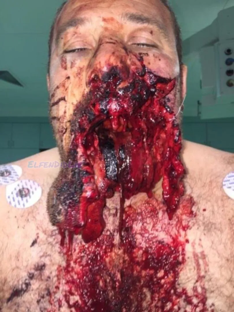Facial trauma due to a suicide attempt with a gunshot
