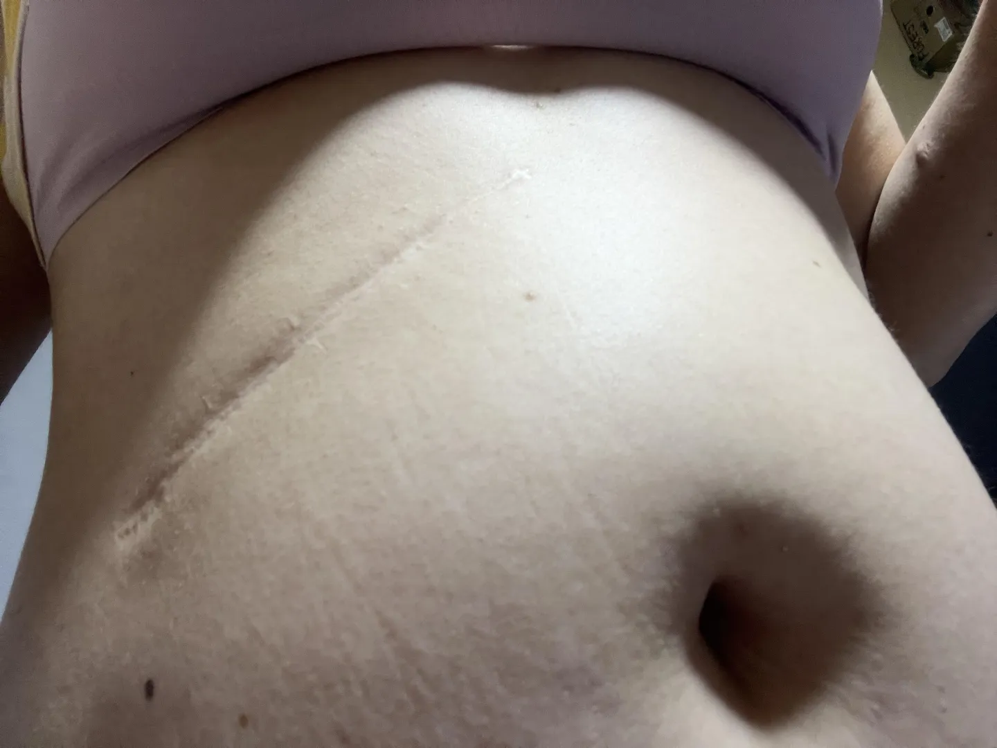 First time showing my scar in public