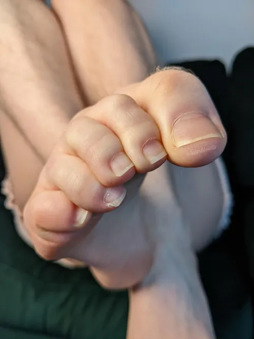 Hairy toes and bare nails