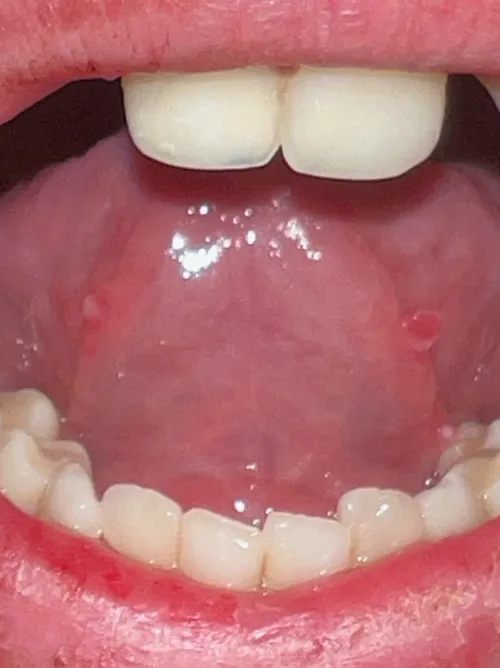 Is this something I should worry about its a bit painful but only when I move my tongue