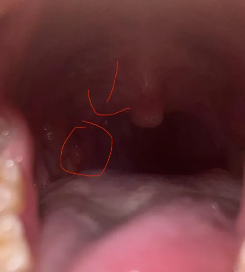 Lump near right tonsil flap idk what’s going on I’m scared ! Help