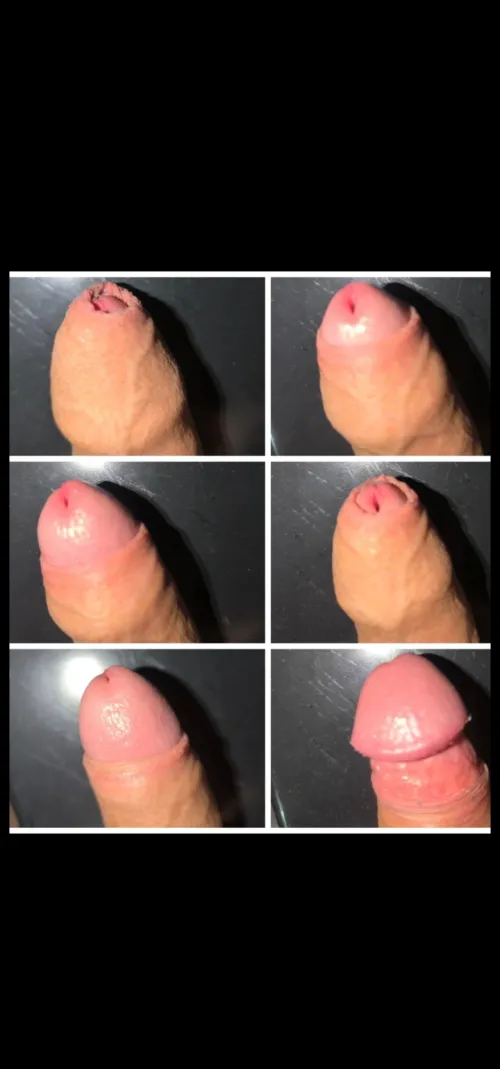 My experience with phimosis