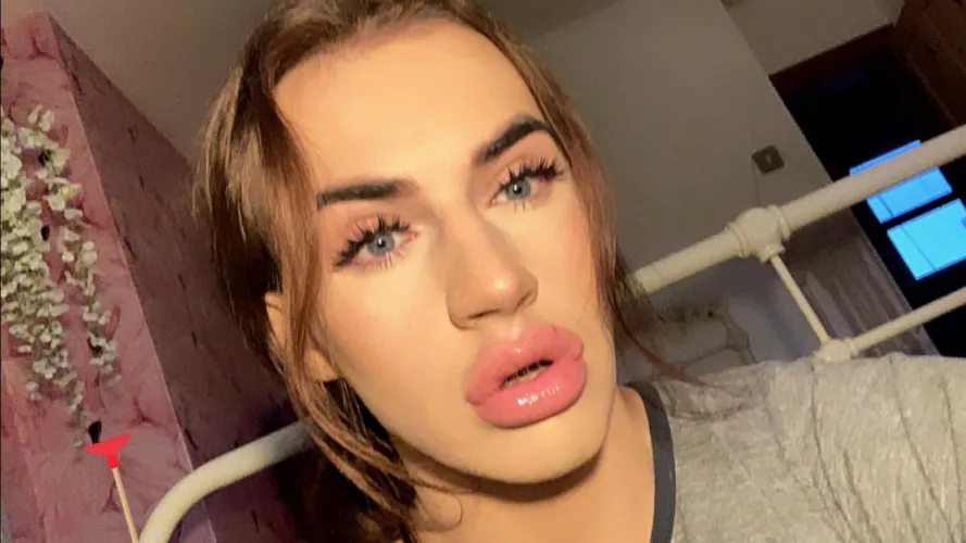 My freshly filled lips