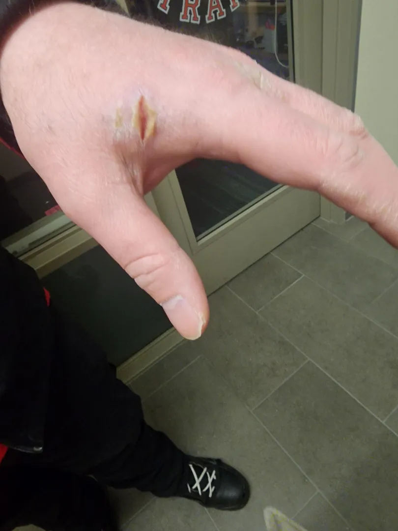 My hand has done this every year for 15 years.