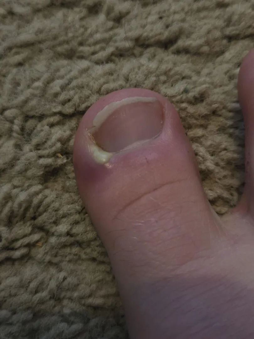 My toe has hurt the last day or so, this is what it looks like. What seems to be the issue here and what is my course of action?