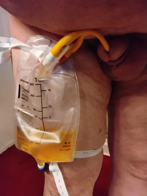 New catheter- installed at the urologist office.