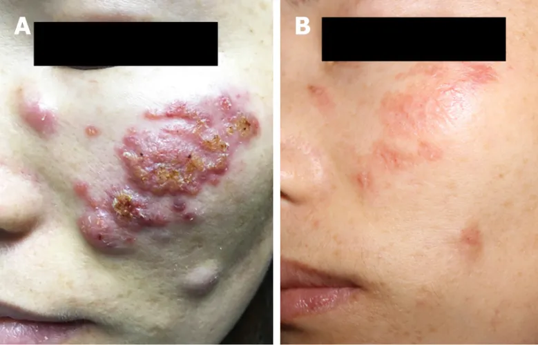 Patient got an injection to the face of hyaluronic acid fillers. The result was a granuloma. They treated the granuloma but patient was left scarred.